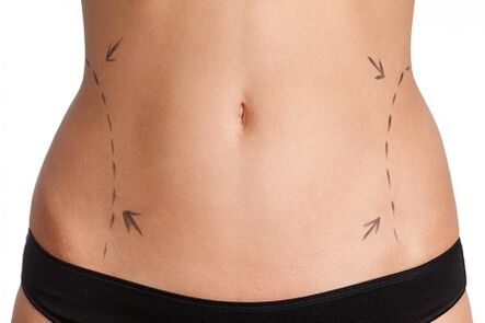 Liposuction